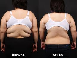 Back Lift Surgery – Eliminating Back Fat Rolls with the New Bra-Line